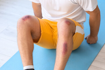 Sporty man with bruises on body training in gym