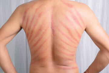 The red mark on the man's back was caused by Gua Sha. Gua sha is a natural alternative therapy to...