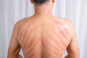 The red mark on the man's back was caused by Gua Sha. Gua sha is a natural alternative therapy to...