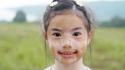 Little cute alpha young albino vitiligo small school girl relax smile look at camera. Real melanin...
