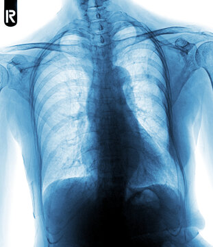 Film chest x-ray show interstitial infiltration both lung