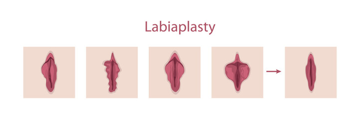 Labiaplasty
