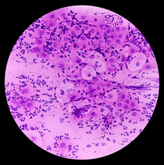 Pap's smear. Reactive cellular changes associated with severe inflammation. Atrophic changes(Bethesda cervical reporting system). Cervical cancer screening. Abnormal squamous epithelial cells.