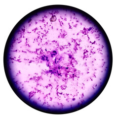 Thyroid nodule (FNA cytology): Cellular follicular lesion, microscopic show cellular material of regular thyroid follicular epithelial cells, background show histiocytes and blood.