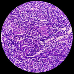 Lymph node (biopsy): Hodgkin's lymphoma, mixed cellularity, monotonous population of lymphocytes,...