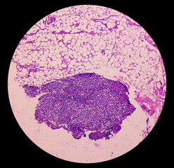 Lymph node (biopsy): Hodgkin's lymphoma, mixed cellularity, monotonous population of lymphocytes, histiocytes, plasma cell, large mononuclear cells. Hodgkin's disease.