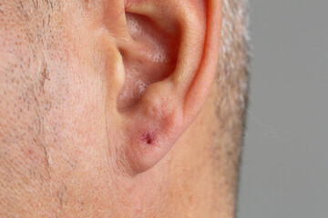 Piercing ear hole with irritation due to bacterial infection