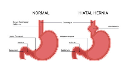Healthy stomach and hiatal hernia infographic - obrazy, fototapety, plakaty