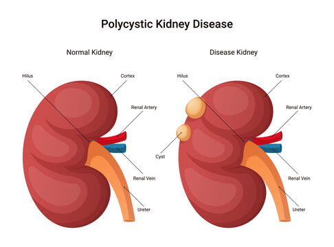 Polycystic kidney disease infographic, normal kidney and diseased kidney design illustration