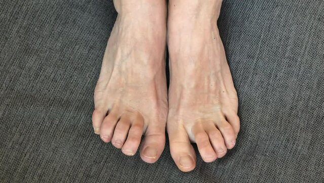 Toes problem nails. Top view