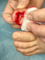 Tearing of the nail and bleeding of the nail bed on children's leg.