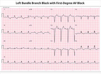 ECG First-Degree AV Block with LBBB (Left Bundle Branch Block) - 12 Leads ECG Paper - Vector - Medical Illustration