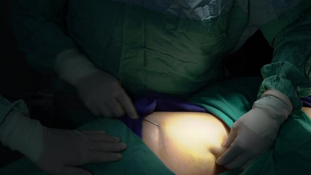 A middle-aged woman who had stem cells removed from her abdomen and legs during plastic surgery.