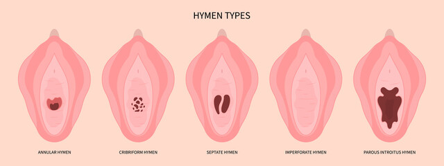 Anatomy of hymen before Hymenoplasty surgery for repair the procedure in medical - obrazy, fototapety, plakaty