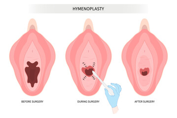 Hymenoplasty surgery for hymen repair the procedure in medical