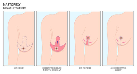 Enlarged correct breast surgery silicone implantation small size droop pain women shape fat transfer lift asymmetrical nipple sag rejuvenate skin scar