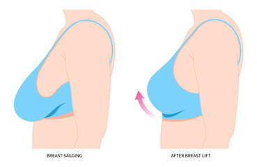 Breast fat transfer lift asymmetrical nipple sag rejuvenate surgery implantation small size droop pain silicone women shape skin scar enlarged correct - obrazy, fototapety, plakaty