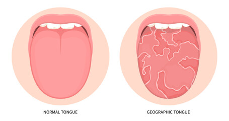 Iron anemia immune system trauma in mouth cancer ulcer swelling oral inflamed pain angular canker sore viral pink burnt throat tonsils gums dry of hunter median celiac virus fungal B12 red fever