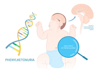 Newborn with Phenylketonuria disorder diagnose inherit problem seizures