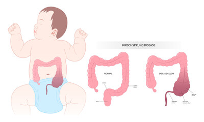 intestinal disease of Hirschsprung's nerves inflammation blocked swollen belly tummy ache sepsis Down keyhole peritonitis incontinence large intestine Diarrhea disorder