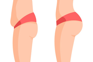 Vector image of a fat and a fit butts and bellys side view. Concept of before losing weight and after doing sports - obrazy, fototapety, plakaty