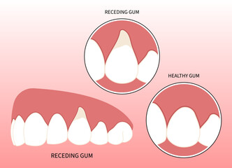 Toothache swelling Teeth dentistry grafting procedure for recession gummy smile buildup Loose black cavity root decay canal abscess oral pain thin injury cosmetic recontouring crown prep