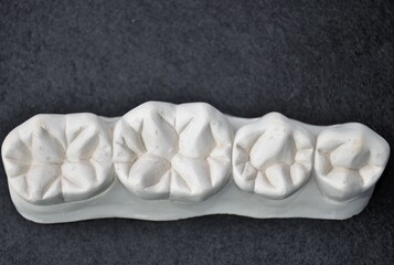 Mandibular premolars and molars in white plaster on a dark background