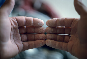 finger tips raw from rock climbing