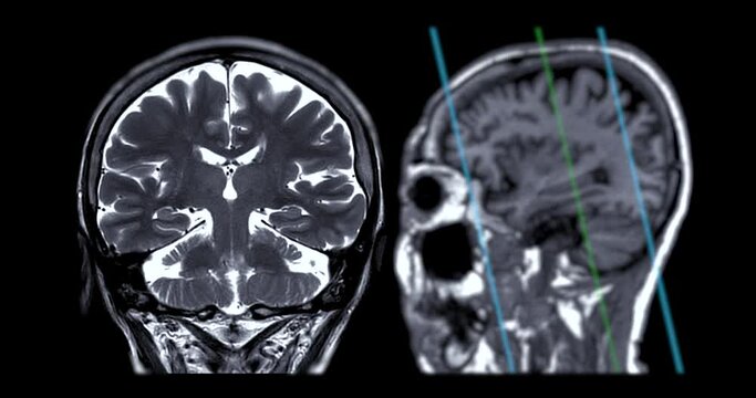 MRI Brain Coronal T2w oblique can help doctors look for conditions dementia.