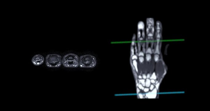 MRI hand T2W for diagnosis bone arthritis , rheumatoid and Tear of ligament.