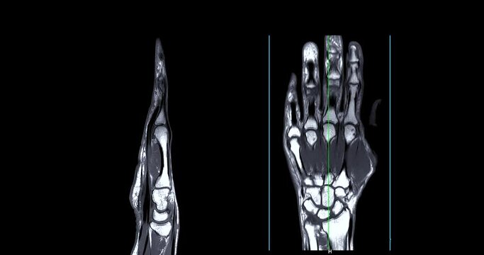 MRI hand T2W for diagnosis bone arthritis , rheumatoid and Tear of ligament.