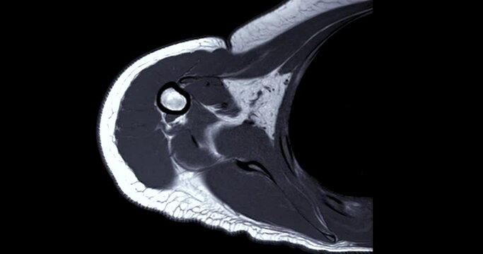 Magnetic Resonance Imaging or MRI of Shoulder Joint T1W for diagnostic shoulder pain.