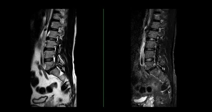 MRI L-S spine or lumbar spine sagittal T2W and T2W Fat suppression for diagnosis spinal cord compression.