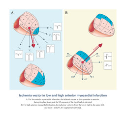 The anterior wall myocardial infarction in different parts produces different ischemic vectors, which ultimately leads to different ECG lead distribution of sT segment elevation.