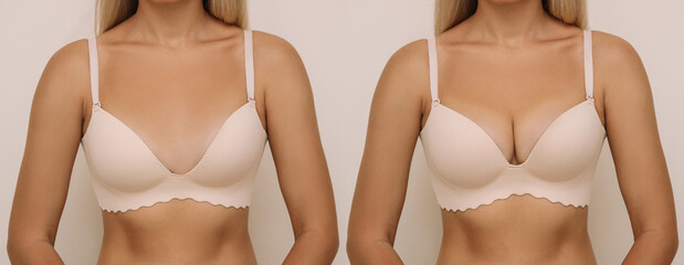 Young tanned blonde woman in bra before and after breast augmentation with silicone implants. The...
