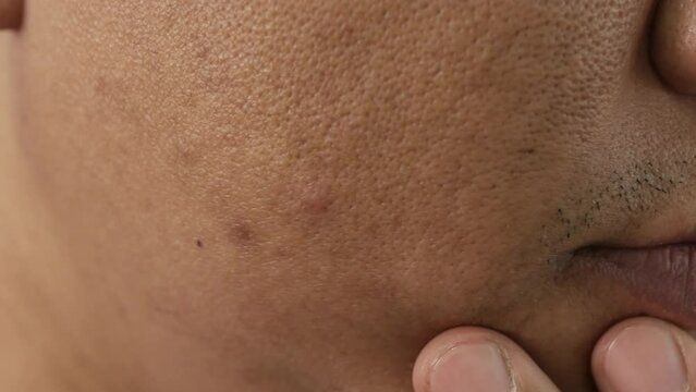 Cheeks of people with skin problems, acne, large pores and dull skin