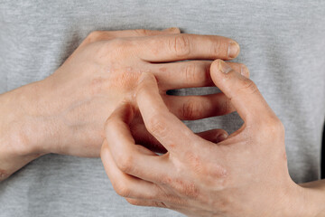 Close-up of men's hands with dry skin damage. The concept of dermatology is human hands with skin...