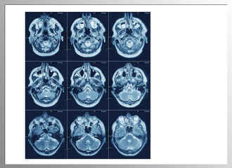  Magnetresonanztomographie MRT / Kernspintomographie / Schichtaufnahmen