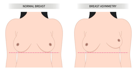 One breast bigger than pain examine density milk gland duct test Lump Malignant cyst large woman Implant Sagging mass size Lift Fat Transfer small shape
