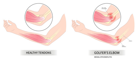 sport injury in pronation wrist Golfer's elbow pain common radial flexion rotator cuff of Cozen's with Mill's test nerve and Tricep extensor carpi radialis brevis muscle rupture - obrazy, fototapety, plakaty