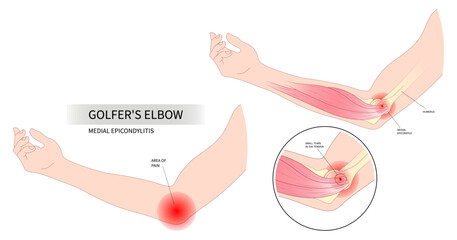 Anatomy common radial flexion nerve for Golfer's elbow pain sport injury in pronation wrist rotator cuff of Cozen's with Mill's test and Tricep extensor carpi radialis brevis muscle rupture - obrazy, fototapety, plakaty