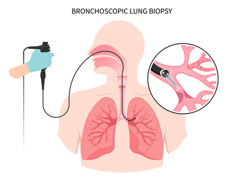 Medical bronchi washing for chronic asthma mucus plug Bronchioles tumor cancer malignant cell surgical with flexible fiber optic guided chest X RAY test lymph node masses