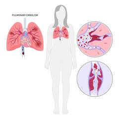 Post thrombotic lung edema blood clot chronic cough chest pain of stroke leg thrombus air spider vein high block vessel arteries acute limb ischemia swelling knee ulcer foot calf