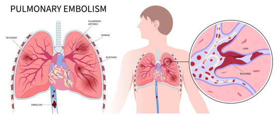 Post thrombotic lung edema blood clot chronic cough chest pain of stroke leg thrombus air spider vein high block vessel arteries acute limb ischemia swelling knee ulcer foot calf - obrazy, fototapety, plakaty