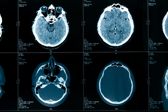 Professional medical MRI X-ray or CT picture scan of male brain,human skull,head.Medical healthcare