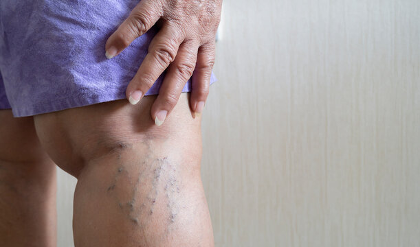 Varicose veins in an elderly woman. Inflamed dilated veins in the legs.