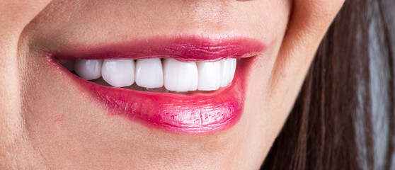 creating a new smile by ceramic crowns and veneers