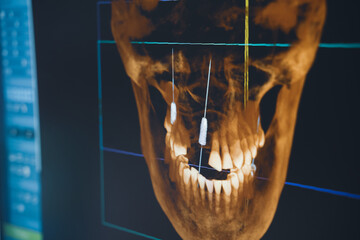 dental radiography x-ray on digital screen in dental clinic