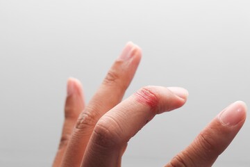 Ring finger wound, close up 