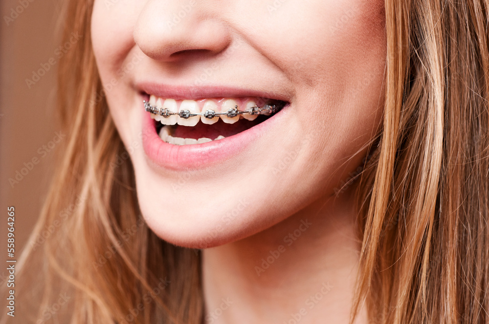 Sticker teeth with braces, close up